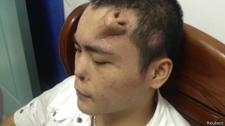 Cómo hacer crecer una nariz en la frente