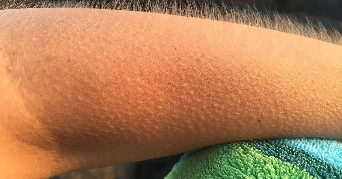 El fenómeno del frisson: cuando la música te pone la piel de gallina.