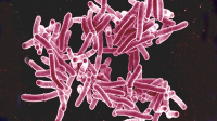 Amenaza mundial: brote de tuberculosis incurable